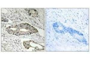 Immunohistochemistry analysis of paraffin-embedded human colon carcinoma tissue, using EPN3 antibody.