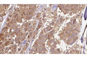 ABIN6278939 at 1/100 staining Human Melanoma tissue by IHC-P. (CYB5R4 antibody  (N-Term))