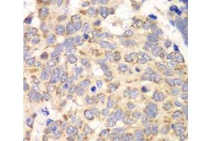 Immunohistochemistry of paraffin-embedded Human esophageal cancer using HAGH Polyclonal Antibody at dilution of 1:100 (40x lens).