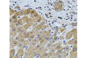 Immunohistochemistry of paraffin-embedded Human liver damage using FoxO3a Polyclonal Antibody at dilution of 1:100 (40x lens). (FOXO3 antibody)