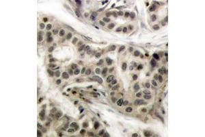 Immunohistochemistry of paraffin-embedded human breast carcinoma using Phospho-NFKB1-S337 antibody (ABIN2987371). (NFKB1 antibody  (pSer337))