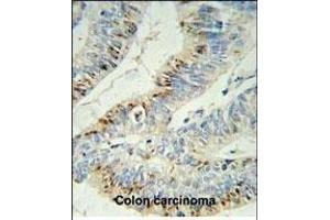PHL Antibody (C-term) (ABIN652395 and ABIN2841923) IHC analysis in formalin fixed and paraffin embedded colon carcinoma followed by peroxidase conjugation of the secondary antibody and DAB staining. (PHLPP2 antibody  (C-Term))