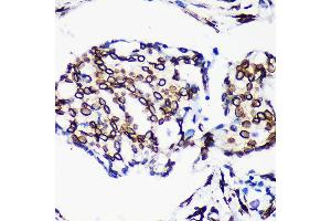 Immunohistochemistry of paraffin-embedded Human breast cancer using Lamin A/C antibody (ABIN7268177) at dilution of 1:200 (40x lens).