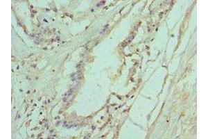 Immunohistochemistry of paraffin-embedded human prostate tissue using ABIN7156772 at dilution of 1:100 (IL11RA antibody  (AA 30-290))