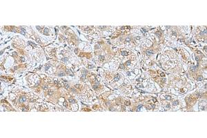 Immunohistochemistry of paraffin-embedded Human liver cancer tissue using DHX58 Polyclonal Antibody at dilution of 1:60(x200) (DHX58 antibody)