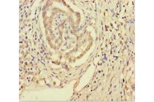 Immunohistochemistry of paraffin-embedded human pancreatic cancer using ABIN7170557 at dilution of 1:100 (SMPD3 antibody  (AA 401-655))