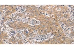 Immunohistochemistry of paraffin-embedded Human gastric cancer using NFE2L1 Polyclonal Antibody at dilution of 1:30 (NFE2L1 antibody)