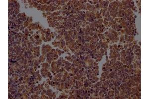 IHC image of ABIN7127384 diluted at 1:100 and staining in paraffin-embedded human lung cancer performed on a Leica BondTM system. (Recombinant Caspase 2 antibody)