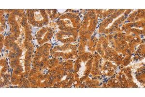 Immunohistochemistry of paraffin-embedded Human thyroid cancer tissue using TNFRSF8 Polyclonal Antibody at dilution 1:60 (TNFRSF8 antibody)