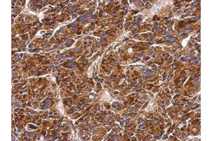 IHC-P Image Immunohistochemical analysis of paraffin-embedded human hepatoma, using MMAB, antibody at 1:500 dilution.