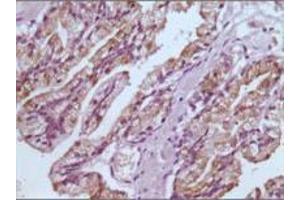 Immunohistochemical analysis of paraffin-embedded human prostate tissues using GSTP1 mouse mAb with DAB staining.