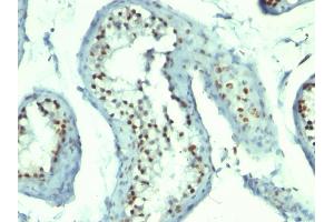 Formalin-fixed, paraffin-embedded human Testicular Carcinoma stained with Nucleolin Monoclonal Antibody (364-5 + NCL/902). (Nucleolin antibody)