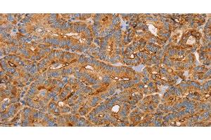Immunohistochemistry of paraffin-embedded Human thyroid cancer using CD59 Polyclonal Antibody at dilution of 1:50 (CD59 antibody)