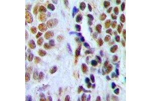 Immunohistochemical analysis of DDB2 staining in human breast cancer formalin fixed paraffin embedded tissue section. (DDB2 antibody)
