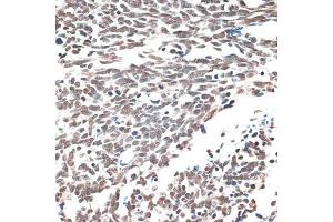 Immunohistochemistry of paraffin-embedded human lung cancer using AQR antibody (ABIN6133411, ABIN6137057, ABIN6137058 and ABIN6221662) at dilution of 1:100 (40x lens). (AQR antibody  (AA 400-700))