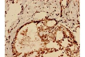 Immunohistochemistry analysis of human breast cancer using ABIN7147553 at dilution of 1:100 (CHID1 antibody  (AA 20-393))