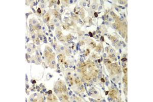 Immunohistochemistry of paraffin-embedded human gastric using MMP9 antibody at dilution of 1:100 (x400 lens).