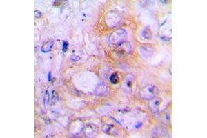 Immunohistochemical analysis of BMP2 staining in human lung cancer formalin fixed paraffin embedded tissue section.