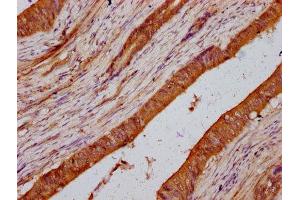 IHC image of ABIN7158363 diluted at 1:200 and staining in paraffin-embedded human colon cancer performed on a Leica BondTM system. (LMO7 antibody  (AA 1301-1465))