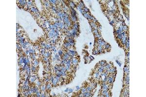 Immunohistochemistry of paraffin-embedded Human gastric cancer using MRPL28 Polyclonal Antibody at dilution of 1:100 (40x lens). (MRPL28 antibody)