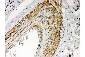 IHC-P: PKC iota antibody testing of human lung cancer tissue (PKC iota antibody  (AA 21-214))