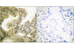 Immunohistochemistry analysis of paraffin-embedded human lung carcinoma, using Cyclin D3 (Phospho-Thr283) Antibody.