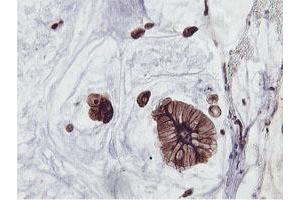 Immunohistochemical staining of paraffin-embedded Adenocarcinoma of Human colon tissue using anti-PFKP mouse monoclonal antibody. (PFKP antibody)