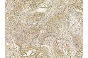 ABIN6262132 and ABIN6276632 at 1/100 staining human cervical carcinoma by IHC-P. (CD236/GYPC antibody  (Internal Region))