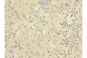 Immunohistochemistry of paraffin-embedded human liver cancer using ABIN7175576 at dilution of 1:100 (CACNG7 antibody  (AA 156-275))