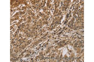 Immunohistochemistry of Human gastric cancer using CALU Polyclonal Antibody at dilution of 1:40