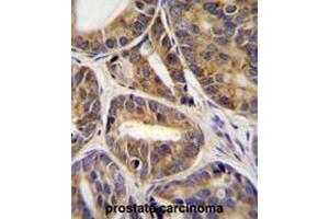 RNF215 Antibody (C-term) immunohistochemistry analysis in formalin fixed and paraffin embedded human prostate carcinoma tissue followed by peroxidase conjugation of the secondary antibody and DAB staining. (RNF215 antibody  (C-Term))