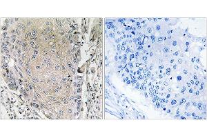 Immunohistochemistry analysis of paraffin-embedded human lung carcinoma tissue using CBLN3 antibody. (CBLN3 antibody)