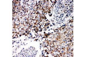 Anti-REA antibody, IHC(P) IHC(P): Human Lung Cancer Tissue