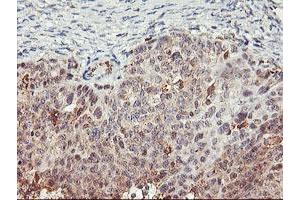 Immunohistochemical staining of paraffin-embedded Adenocarcinoma of Human ovary tissue using anti-TULP3 mouse monoclonal antibody.
