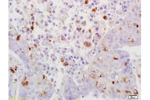 Formalin-fixed and paraffin embedded human lung carcinoma labeled with Rabbit Anti-JNK1/2/3 Polyclonal Antibody, Unconjugated (ABIN747713) at 1:200 followed by conjugation to the secondary antibody and DAB staining (JNK antibody  (AA 151-250))