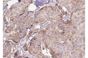 ABIN6272975 at 1/100 staining Human breast cancer tissue by IHC-P. (PPAT antibody  (N-Term))
