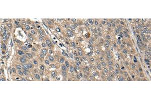 Immunohistochemistry of paraffin-embedded Human liver cancer tissue using FCGR1A Polyclonal Antibody at dilution of 1:35(x200) (FCGR1A antibody)
