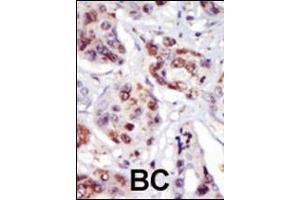 Formalin-fixed and paraffin-embedded human cancer tissue reacted with the primary antibody, which was peroxidase-conjugated to the secondary antibody, followed by AEC staining. (PIP5K2 gamma (AA 333-364), (C-Term) antibody)