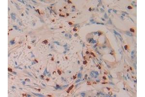 Detection of AZU in Human Bile duct cancer Tissue using Polyclonal Antibody to Azurocidin (AZU) (Azurocidin antibody  (AA 23-247))