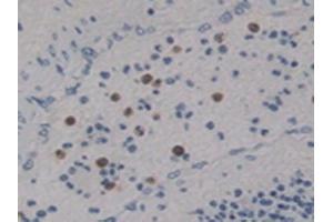 Detection of Ntn4 in Human Lung Cancer Tissue using Polyclonal Antibody to Netrin 4 (Ntn4) (Netrin 4 antibody  (AA 349-592))