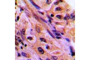 Immunohistochemical analysis of CDC42EP4 staining in human lung cancer formalin fixed paraffin embedded tissue section. (CDC42EP4 antibody)