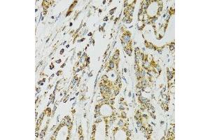 Immunohistochemistry of paraffin-embedded human colon carcinoma using HSPA9 antibody.