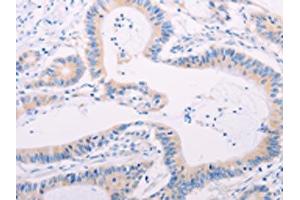 The image on the left is immunohistochemistry of paraffin-embedded Human colon cancer tissue using ABIN7189656(ADAMTS17 Antibody) at dilution 1/60, on the right is treated with synthetic peptide. (ADAMTS17 antibody)