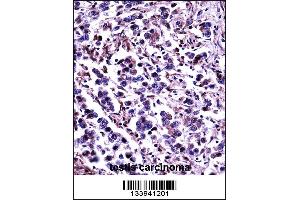 CAPN11 Antibody immunohistochemistry analysis in formalin fixed and paraffin embedded human testis carcinoma followed by peroxidase conjugation of the secondary antibody and DAB staining.