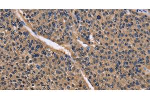 Immunohistochemistry of paraffin-embedded Human liver cancer using IDH1 Polyclonal Antibody at dilution of 1:50
