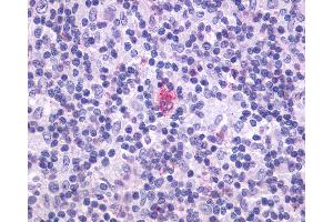 Anti-CXCR5 antibody IHC of human Lymph Node, Hodgkins Lymphoma. (CXCR5 antibody  (Cytoplasmic Domain))