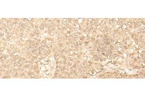 Immunohistochemistry of paraffin-embedded Human ovarian cancer tissue using FAH Polyclonal Antibody at dilution of 1:40(x200) (FAH antibody)