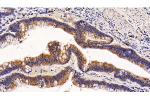 Detection of KRT6A in Human Colorectal cancer Tissue using Polyclonal Antibody to Keratin 6A (KRT6A) (KRT6A antibody  (AA 163-468))