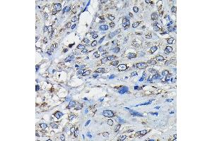 Immunohistochemistry of paraffin-embedded human esophageal cancer using RanG Rabbit pAb (ABIN6128613, ABIN6146681, ABIN6146683 and ABIN6217306) at dilution of 1:50 (40x lens). (RANGAP1 antibody  (AA 398-587))