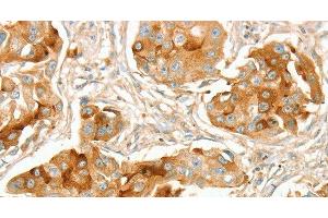 Immunohistochemistry of paraffin-embedded Human breast cancer using ACE1 Polyclonal Antibody at dilution of 1:70 (Angiotensin I Converting Enzyme 1 antibody)